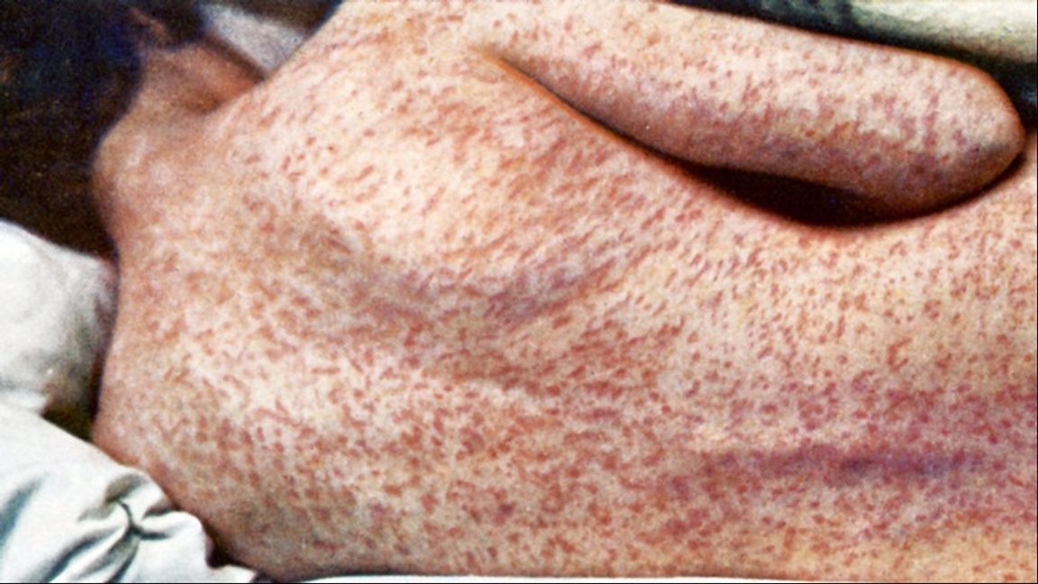 Mässling är mycket smittsam och kan leda till allvarliga sjukdomstillstånd. Foto: Wellcome Trust (CC BY-SA 4.0)