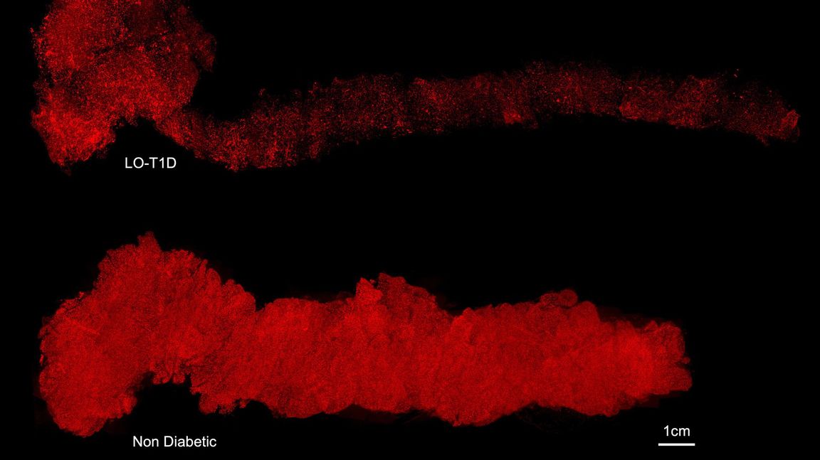 3D-bilder av hela mänskliga bukspottkörtlar med insulin infärgat i rött. Trots tydliga skillnader fanns hundratusentals insulinproducerande celler kvar hos donatorn med typ 1-diabetes. Foto: Umeå Universitet