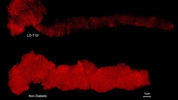 3D-bilder av hela mänskliga bukspottkörtlar med insulin infärgat i rött. Trots tydliga skillnader fanns hundratusentals insulinproducerande celler kvar hos donatorn med typ 1-diabetes. Foto: Umeå Universitet