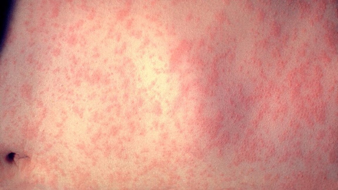 Foto: CDC/Dr. Heinz F. Eichenwald