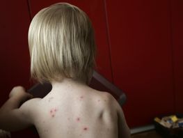 Liten pojke med kliande prickar orsakade av vattkoppor. Arkivbild. Foto: Fredrik Sandberg/TT