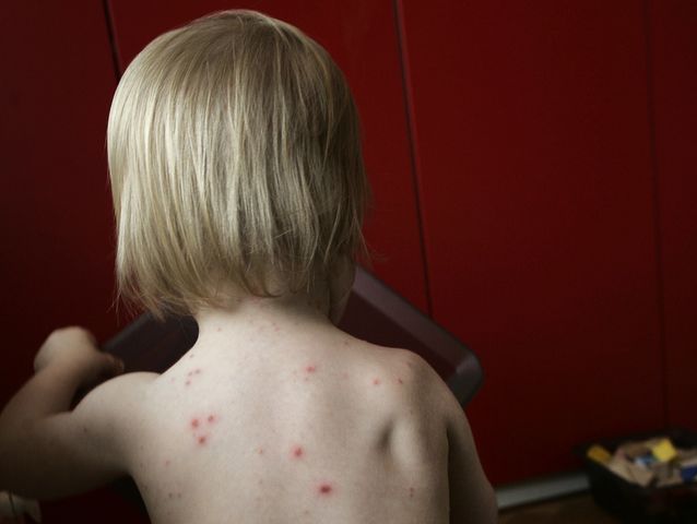 Liten pojke med kliande prickar orsakade av vattkoppor. Arkivbild. Foto: Fredrik Sandberg/TT