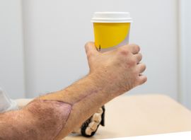 En dubbel handtransplantation har genomförts på Södersjukhuset. Pressbild. Foto: Clas Fröhling