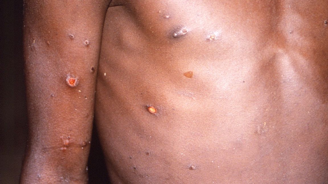 En bild på apkoppor från 1997 som distribuerats av CDC, USA:s motsvarighet till Folkhälsomyndigheten. Foto: CDC via AP/TT